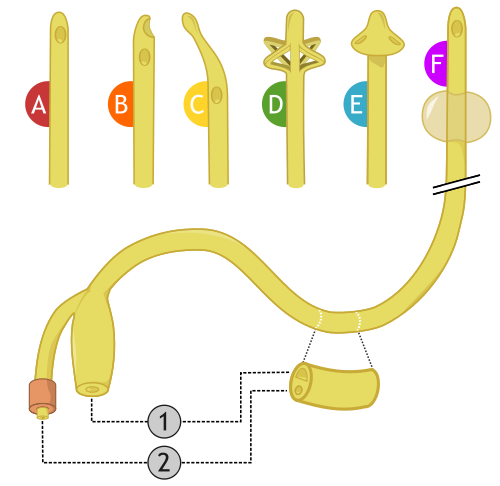 sondaje vesical ejemplo