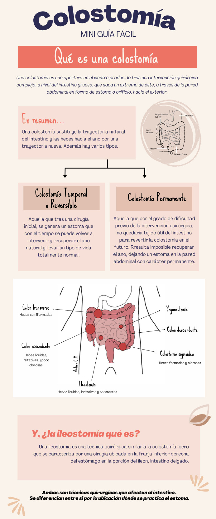 infografia colostomia